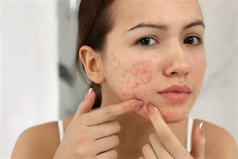 7 Rahasia Skincare Untuk Kulit Berjerawat Bebas Noda!