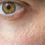 Cara Mengatasi Milia pada Kulit