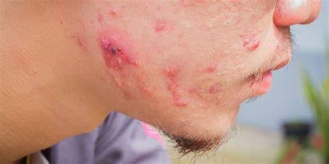 Cystic Acne