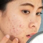 5 Jenis Jerawat yang Paling Umum dan Cara Penanganannya