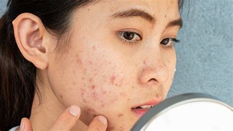 5 Jenis Jerawat yang Paling Umum dan Cara Penanganannya