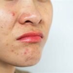 Penyebab dan Cara Mengatasi Bruntusan pada Kulit Wajah