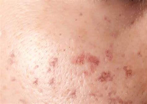 Post-Inflammatory Hyperpigmentation