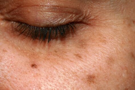 Age Spots