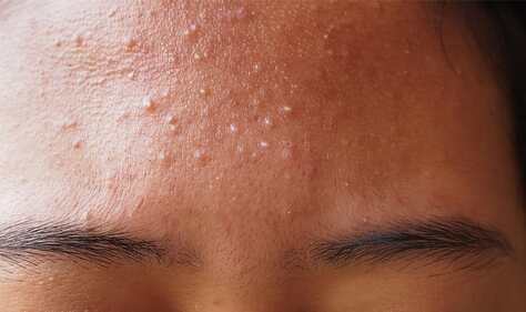 fungal-acne